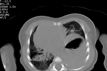 Cứu sống trẻ sơ sinh thoát vị hoành