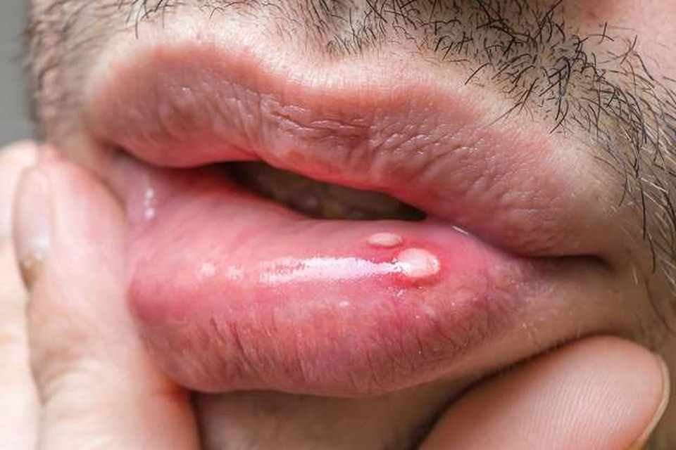 13 dấu hiệu ung thư ở nam giới không nên bỏ qua - 3 13 dấu hiệu ung thư ở nam giới không nên bỏ qua - 3