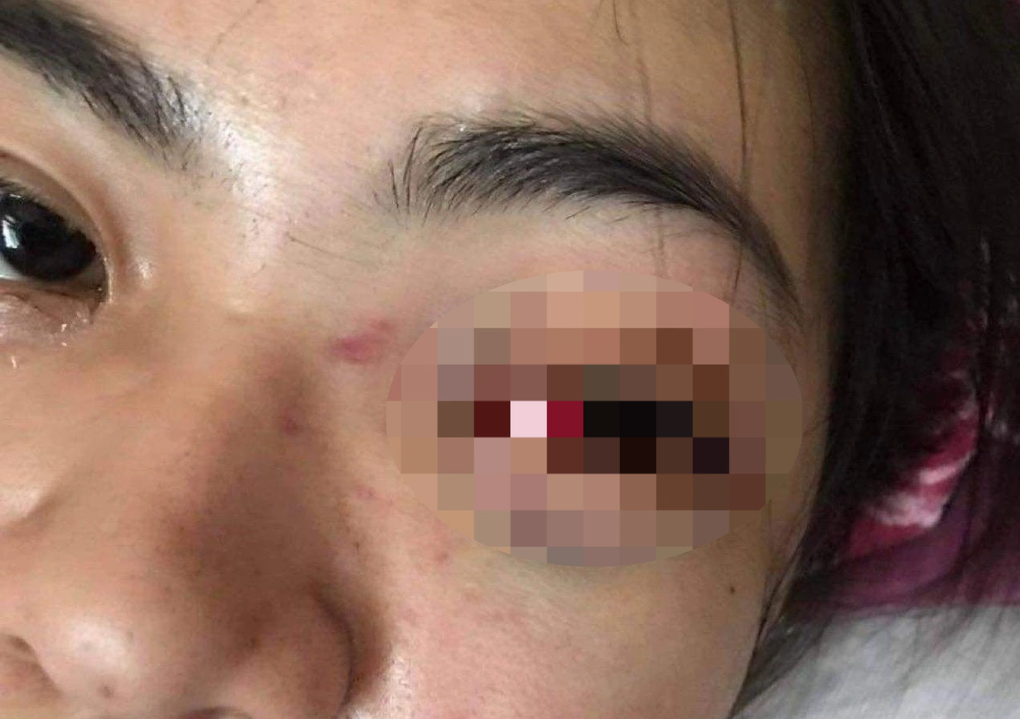 Điều tra vụ nữ sinh lớp 11 nghi bị nhóm bạn đánh tụ máu mắt - 1