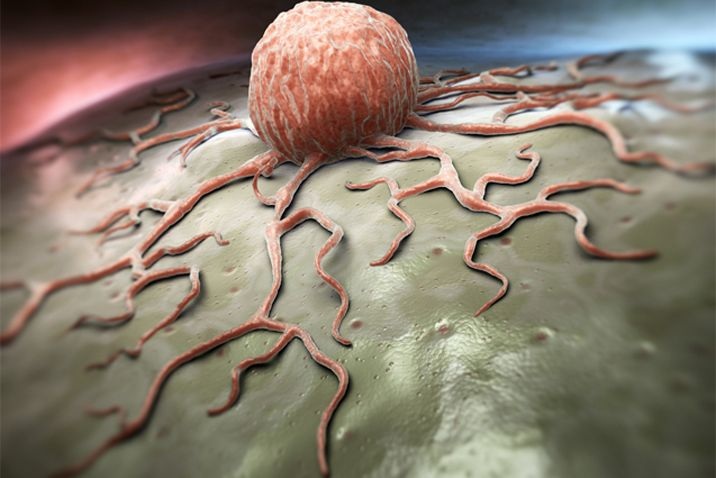 Ngạt mũi, chảy máu cam thường xuyên: Dấu hiệu ung thư dễ bị bỏ qua - 1 Ngạt mũi, chảy máu cam thường xuyên: Dấu hiệu ung thư dễ bị bỏ qua - 1