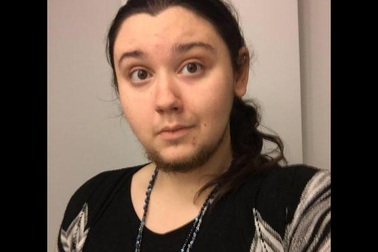 Gặp cô gái mọc râu như đàn ông từ năm 15 tuổi