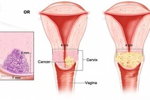 Tiên lượng điều trị ung thư cổ tử cung