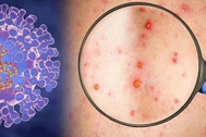 Ca mắc đậu mùa khỉ ở Bến Tre có tiền sử quan hệ tình dục không rõ ràng