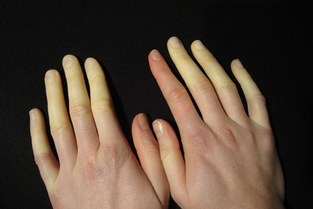 Hội chứng Raynaud là hiện tượng co thắt của các động mạch làm giảm dòng máu nuôi mô cơ quan