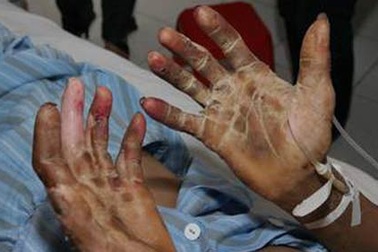 Một người tử vong do nhiễm liên cầu khuẩn lợn