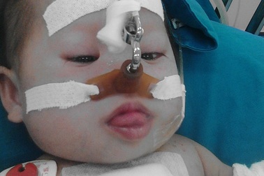 Bé Bích Lộc 8 tháng tuổi đã được mổ tim, diễn biến sức khỏe tốt 