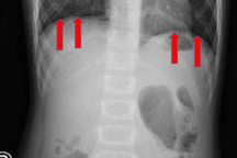 TPHCM: Phát hiện bé gái 8 tuổi thủng ruột nặng sau cơn đau bụng ở trường