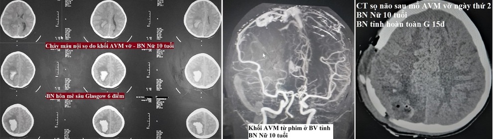 Cứu sống thần kỳ bệnh nhi 10 tuổi chảy máu não - 1 Cứu sống thần kỳ bệnh nhi 10 tuổi chảy máu não - 1