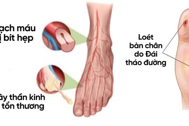 Đái tháo đường: Cách hỗ trợ phòng và giảm tê bì chân tay nguy cơ loét bàn chân