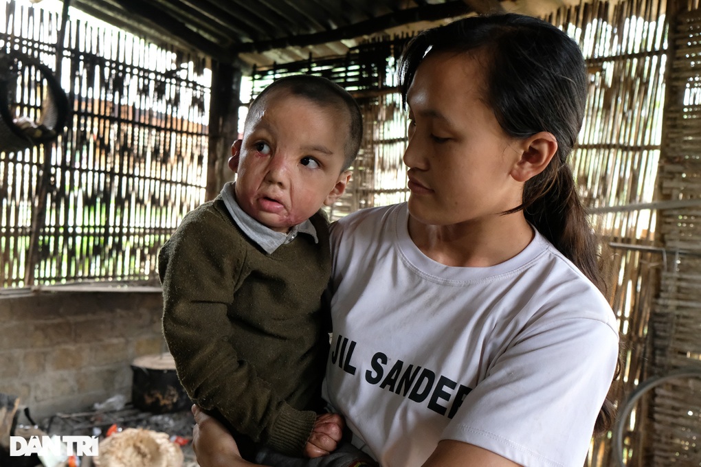 Cậu bé bị biến dạng khuôn mặt vì ngã vào chậu nước nóng đã được tới viện - 4 Cậu bé bị biến dạng khuôn mặt vì ngã vào chậu nước nóng đã được tới viện - 4