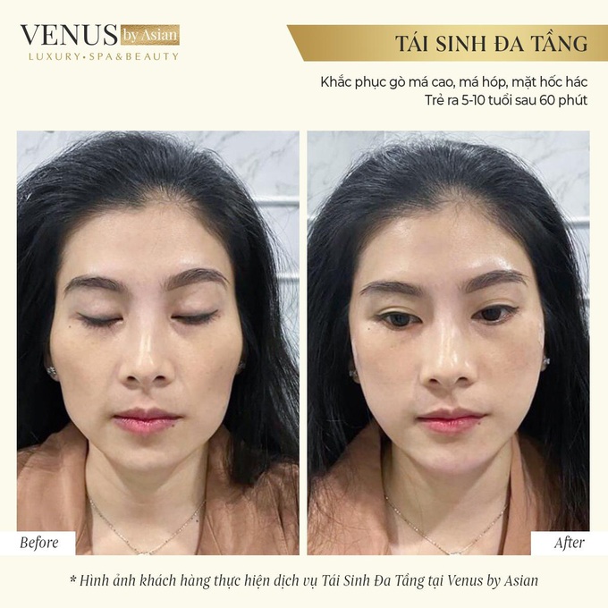 Trẻ ra 10 tuổi xuân chỉ sau 60 phút bằng Tái sinh đa tầng tại Venus by Asian. - Ảnh 3.