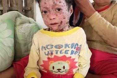 Toàn thân phủ "vỏ cây khô", chàng trai 17 tuổi chỉ nặng 9kg