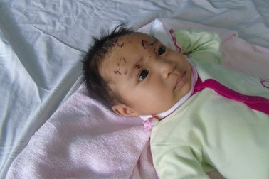 Bé gái 2 tháng tuổi nhập viện cấp cứu vì bị khỉ tấn công