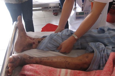 Xuất hiện nhiều nốt hoại tử trên da sau ăn tiết canh