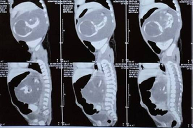 Bé trai chào đời mang theo người em song sinh… trong bụng