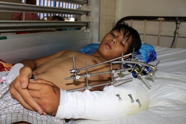 Tài xế 15 tuổi bị xe cuốn rơm nghiền nát cánh tay