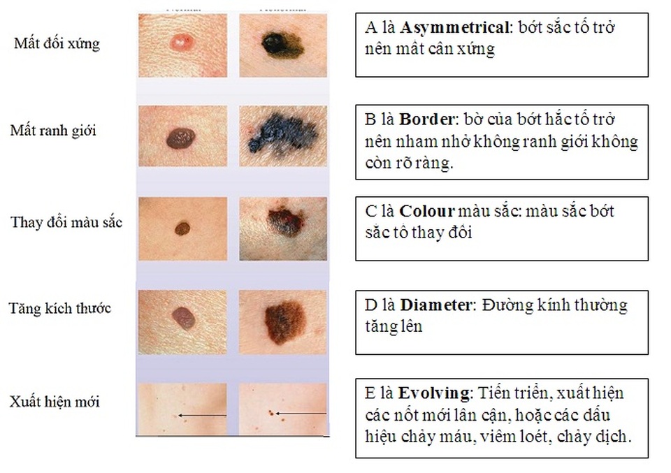 Bác sĩ hướng dẫn cách nhận biết nốt ruồi dễ ác tính hóa - 1 Bác sĩ hướng dẫn cách nhận biết nốt ruồi dễ ác tính hóa - 1