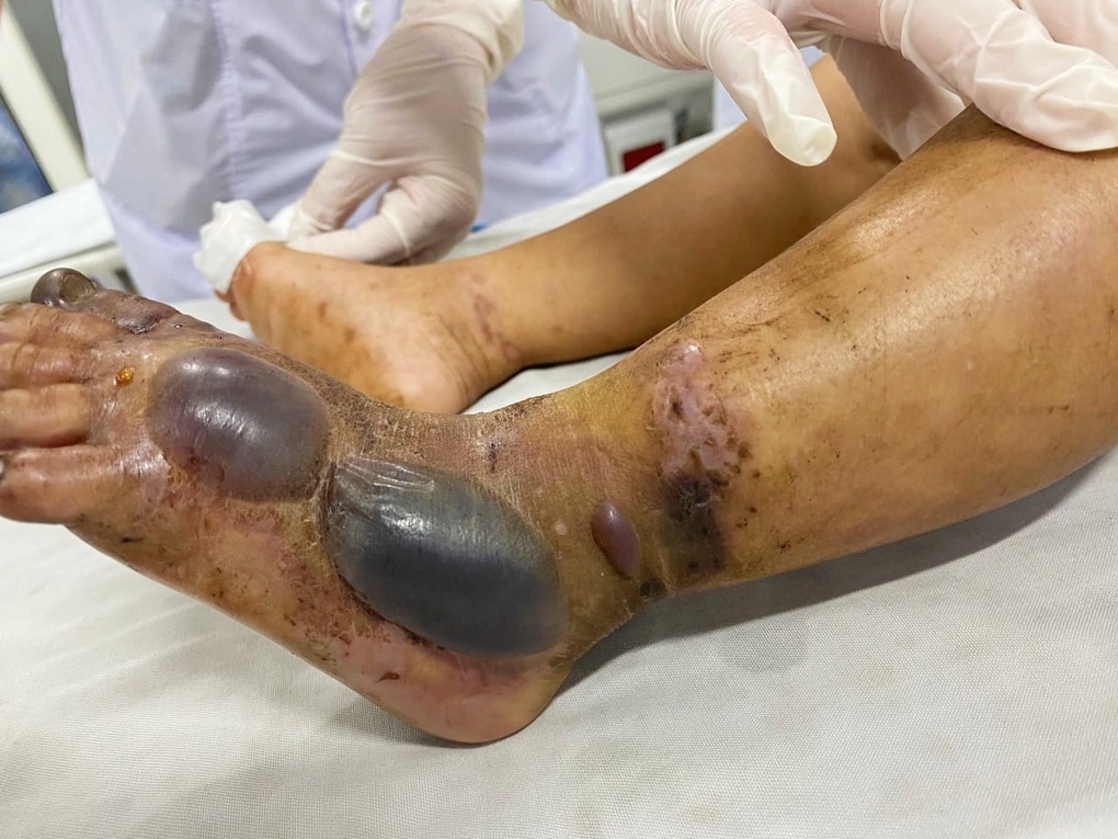 Đang ngủ trên giường, bé trai 2 tuổi bị rắn hổ mang cắn nguy kịch - 1 Đang ngủ trên giường, bé trai 2 tuổi bị rắn hổ mang cắn nguy kịch - 1