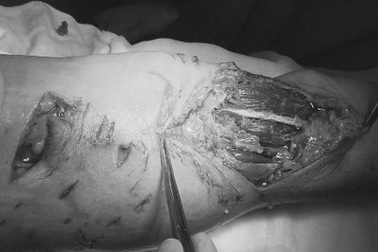 Cụ ông bị chó nhà cắn nát tay chân