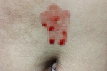 Bé gái 10 tuổi mắc căn bệnh "kỳ lạ" sau dịch: Đổ "mồ hôi máu"