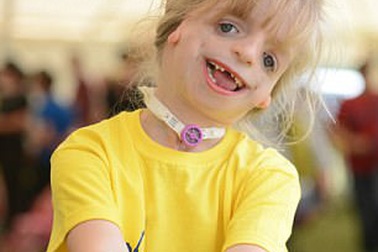 Gặp em bé "hạnh phúc nhất thế gian" dù khuôn mặt biến dạng sau 29 lần phẫu thuật