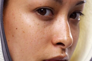 Da mặt chuyển màu này cần đi khám ung thư gan ngay