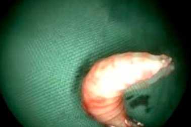 Lấy 50 con dòi khỏi mũi bệnh nhân