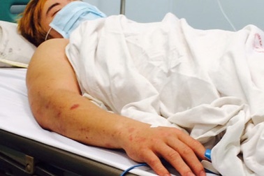 Gia tăng bệnh nhân mắc viêm màng não do não mô cầu