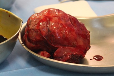 Hi hữu ca cắt u gan nhưng bị “cấm” truyền máu