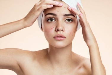 Để da không nổi mụn chi chít, chị em cần biết điều này khi đắp mặt nạ