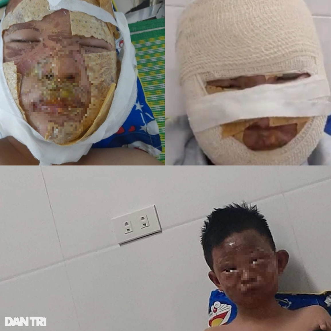 Cơ cực gia đình nghèo và tai họa đổ ập xuống 3 con nhỏ bị bỏng nặng - 2 Cơ cực gia đình nghèo và tai họa đổ ập xuống 3 con nhỏ bị bỏng nặng - 2