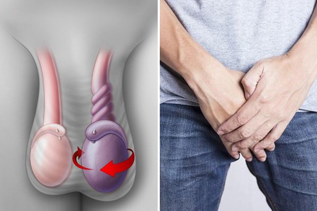 Đang ngủ bỗng đau vùng bìu, bệnh nhân hoảng hồn vì xoắn tinh hoàn - 1 Đang ngủ bỗng đau vùng bìu, bệnh nhân hoảng hồn vì xoắn tinh hoàn - 1