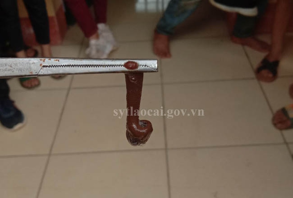Lào Cai: Gắp con đỉa núi dài 6 cm từ mũi bé trai 5 tuổi - 2 Lào Cai: Gắp con đỉa núi dài 6 cm từ mũi bé trai 5 tuổi - 2