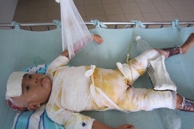 Hơn 600 triệu đồng đến với các em bé bị bỏng nặng