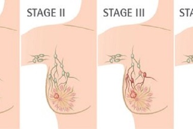 Khám, tầm soát ung thư vú miễn phí tại Bệnh viện Chợ Rẫy