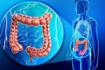 Có yếu tố này, bạn nên bắt đầu tầm soát ung thư đại trực tràng