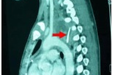 Xương gà đâm thủng thực quản, cháu bé suýt tử vong