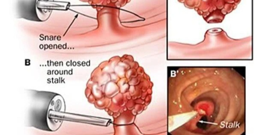 5 dấu hiệu cảnh báo polyp đại trực tràng - 1 5 dấu hiệu cảnh báo polyp đại trực tràng - 1