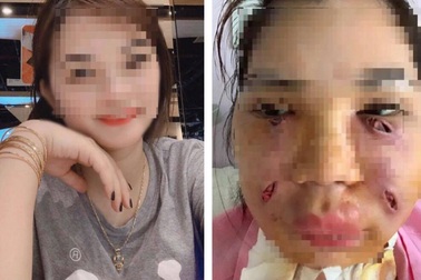 Sốc: Cô gái xinh đẹp mặt biến dạng, chi chít lỗ rò mủ sau 2 mũi tiêm mỡ tự thân