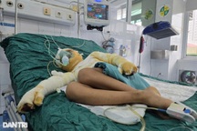 Cha chết lặng khi con 7 tuổi ngã vào nồi bỗng rượu bỏng nặng