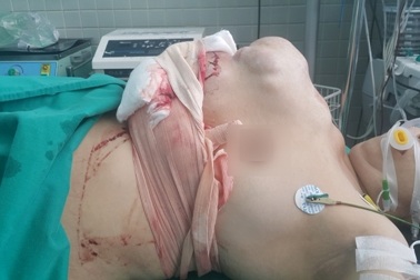 Cứu sống ca xuất huyết ồ ạt do vỡ khối u xương ức