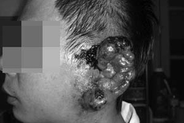 Cắt bỏ khối u máu to như bàn tay “ngự” trên tai bệnh nhân