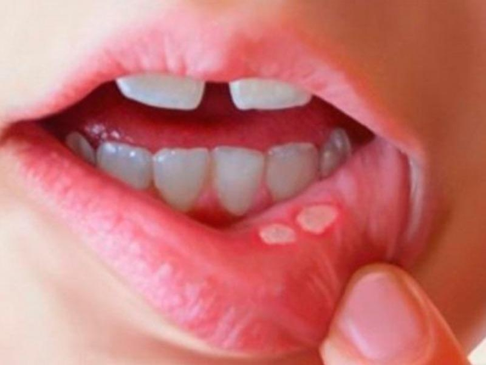Nhiệt miệng, viêm lợi chữa mãi không khỏi – Nguyên nhân và biện pháp khắc phục hiệu quả - 2 Nhiệt miệng, viêm lợi chữa mãi không khỏi – Nguyên nhân và biện pháp khắc phục hiệu quả - 2