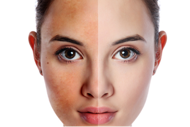 Tạm biệt làn da đen sạm đơn giản ngay tại nhà