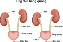 5 dấu hiệu sớm "tố" bạn có thể bị ung thư bàng quang