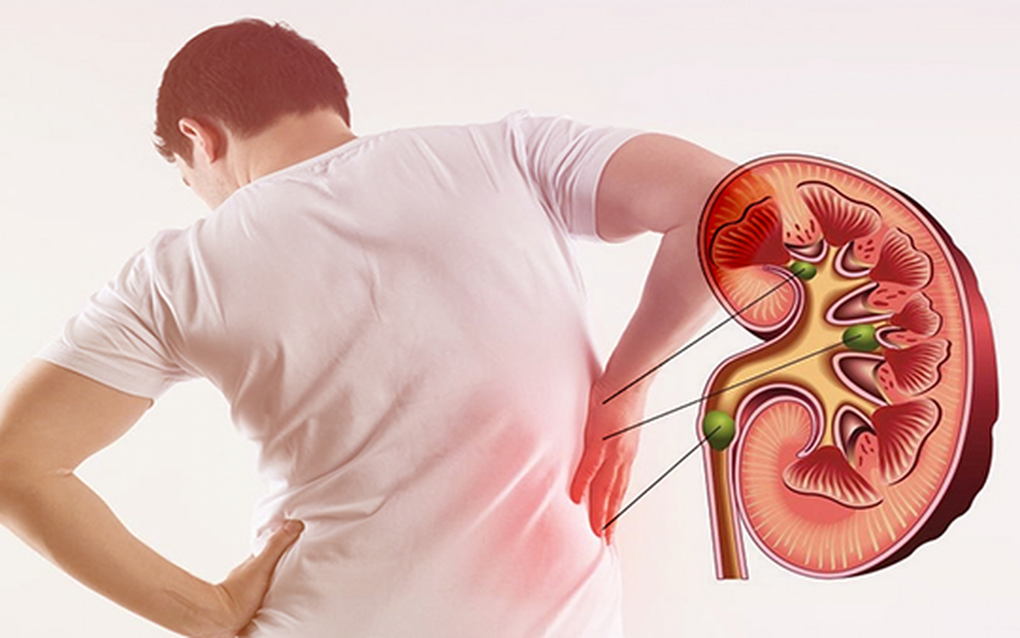 Hỏng thận phải cắt bỏ vì chữa sỏi theo cách này - 1 Hỏng thận phải cắt bỏ vì chữa sỏi theo cách này - 1