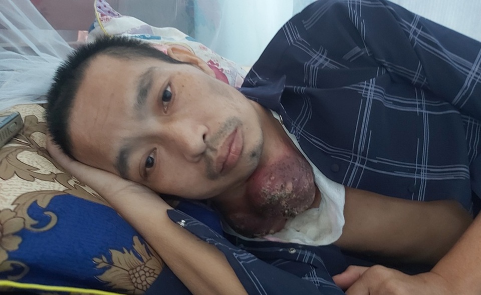 Bạn đọc giúp đỡ người đàn ông mang khối u như những chiếc bát úp vào cổ - 1 Bạn đọc giúp đỡ người đàn ông mang khối u như những chiếc bát úp vào cổ - 1