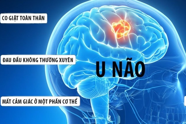 Dấu hiệu u não ác tính - 1