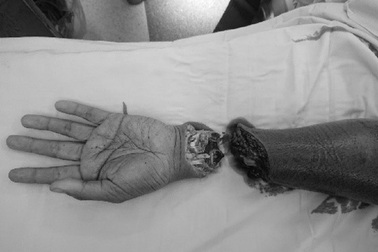 Hồi sinh cánh tay bị chém lìa sau va chạm giao thông