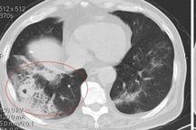 Sàng lọc ung thư phổi như thế nào?